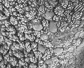 表皮真皮境界部の母斑細胞巣の走査電顕像